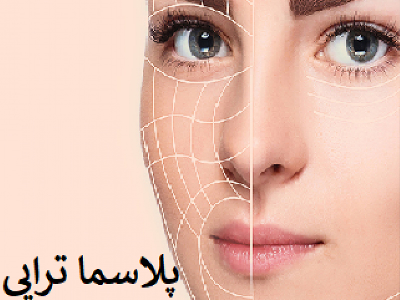 پلاسما تراپی