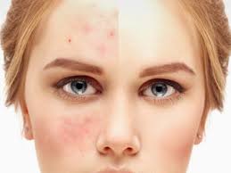 چگونه جای جوش و آکنه را ازبین ببریم