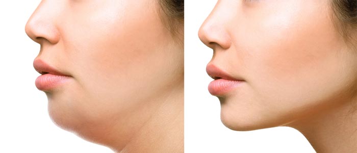 راه های از بین بردن غبغب به سادگی